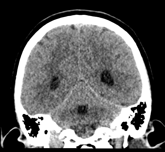 Cerebellar metastases - colorectal adenocarcinoma (Radiopaedia 40947-43652 Coronal non-contrast 65).png
