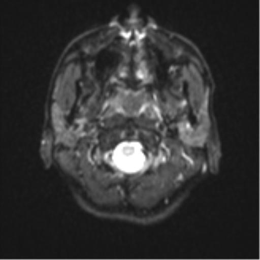 Cerebellar metastasis - adenocarcinoma lung (Radiopaedia 63184-71715 Axial DWI 1).png