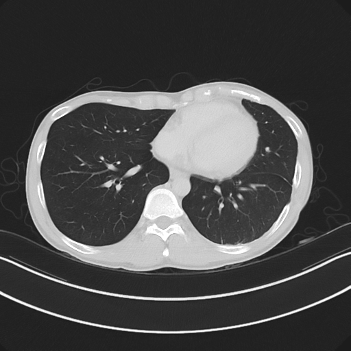Cerebellar metastasis - adenocarcinoma lung (Radiopaedia 63184-71717 Axial lung window 46).png