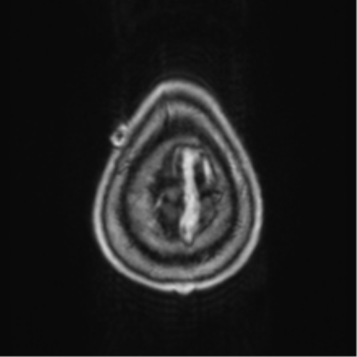Cerebellar metastasis from lung adenocarcinoma (Radiopaedia 86690-102829 Axial T1 C+ 75).png