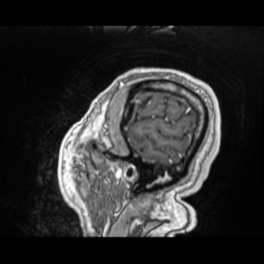 Cerebellar metastasis of pulmonary adenocarcinoma, cavernous venous malformation, and developmental venous anomaly (Radiopaedia 85827-101661 Sagittal T1 C+ 82).jpg