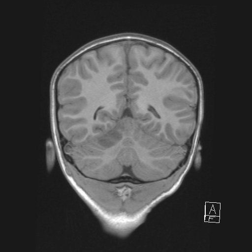File:Cerebellar stroke (Radiopaedia 32202-33150 Coronal T1 44).png
