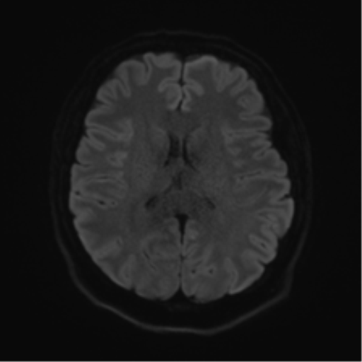 Cerebellopontine angle meningioma (Radiopaedia 48434-53348 Axial DWI 59).png