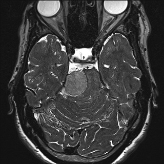 Cerebellopontine angle meningioma (Radiopaedia 72983-83680 Axial FIESTA 50).jpg