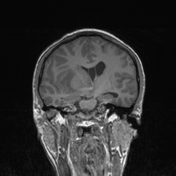 Cerebral abscess (Radiopaedia 24212-24478 Coronal T1 109).jpg