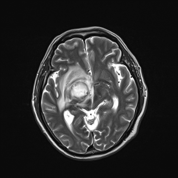 Cerebral abscess (Radiopaedia 26111-26247 Axial T2 30).jpg