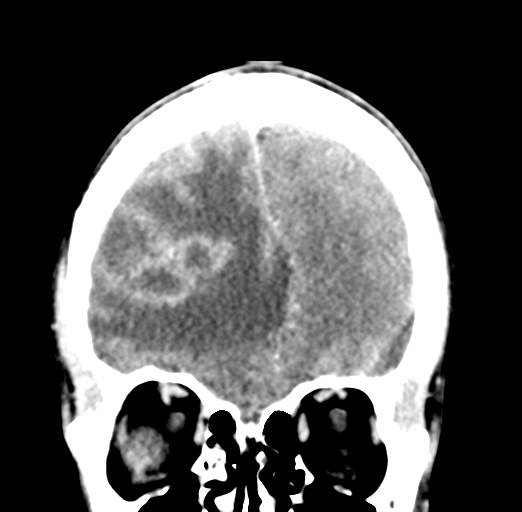 Cerebral abscess (Radiopaedia 60342-68008 Coronal C+ delayed 17).png