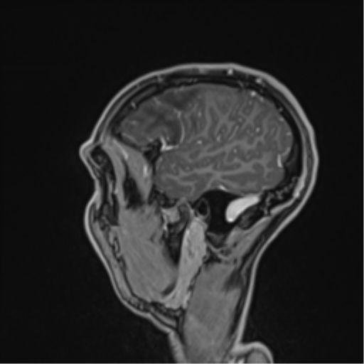 File:Cerebral abscess (Radiopaedia 60342-68009 J 47).png