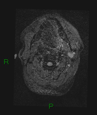 Cerebral abscess and subdural empyema (Radiopaedia 84436-99779 Axial FLAIR 86).jpg