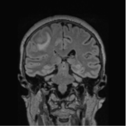 Cerebral abscess from pulmonary arteriovenous malformation (Radiopaedia 86275-102291 Coronal FLAIR 39).png