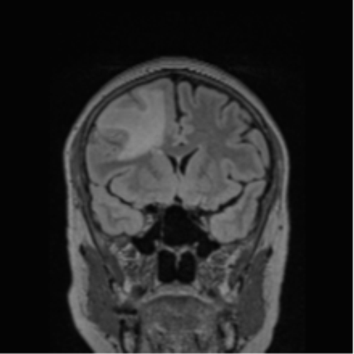 Cerebral abscess from pulmonary arteriovenous malformation (Radiopaedia 86275-102291 Coronal FLAIR 59).png