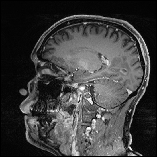 Cerebral abscess with ventriculitis (Radiopaedia 78965-91878 Sagittal T1 C+ 70).jpg