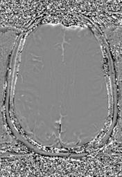 File:Cerebral amyloid angiopathy (Radiopaedia 29129-29518 Axial SWI Phase 24).jpg