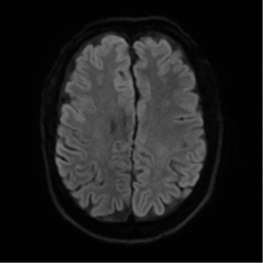 File:Cerebral amyloid angiopathy (Radiopaedia 46082-50433 Axial DWI 45).png