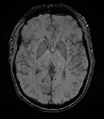 File:Cerebral amyloid angiopathy (Radiopaedia 46082-50433 Axial SWI 43).png