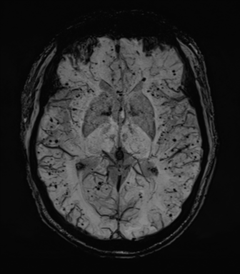Cerebral amyloid angiopathy (Radiopaedia 46082-50433 Axial SWI MIP 38).png