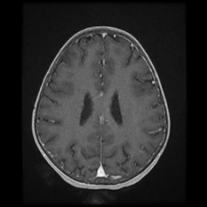 Cerebral and spinal tuberculosis (Radiopaedia 90489-107837 Axial T1 C+ 130).jpg