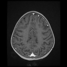 File:Cerebral and spinal tuberculosis (Radiopaedia 90489-107837 Axial T1 C+ 145).jpg