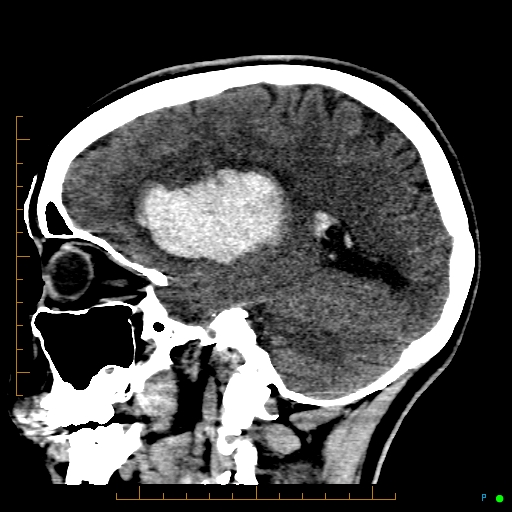 Cerebral arteriovenous malformation (AVM) (Radiopaedia 78162-90706 A 29).jpg