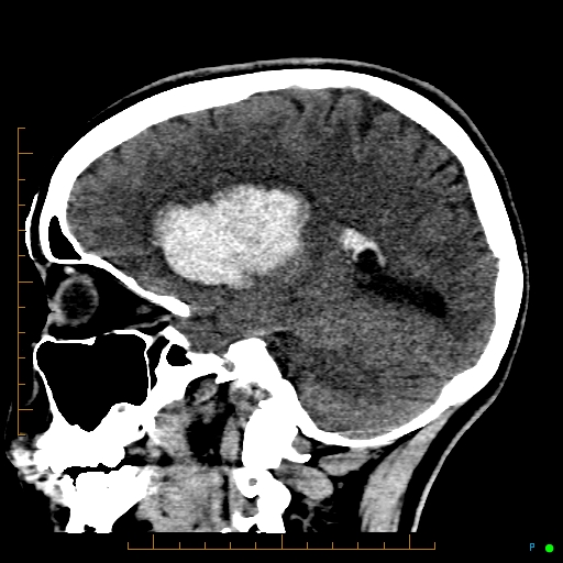 Cerebral arteriovenous malformation (AVM) (Radiopaedia 78162-90706 A 30).jpg
