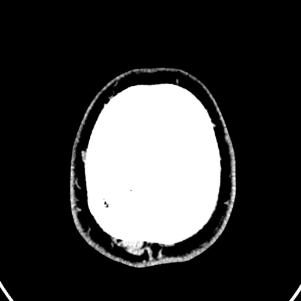 Cerebral arteriovenous malformation (Radiopaedia 37182-39012 Axial non-contrast 47).jpg