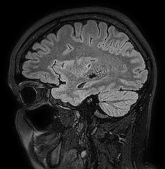 Cerebral arteriovenous malformation (Radiopaedia 74411-85654 Sagittal FLAIR 33).jpg