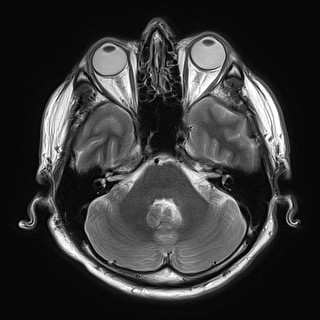 File:Cerebral arteriovenous malformation (Radiopaedia 84015-99245 Axial T2 9).jpg