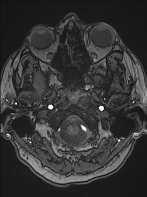 Cerebral arteriovenous malformation (Radiopaedia 84015-99245 Axial TOF 54).jpg
