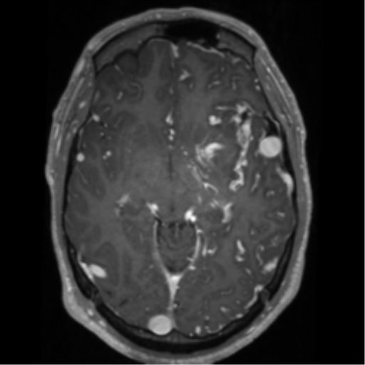 Cerebral arteriovenous malformation - huge (Radiopaedia 35734-37272 Axial T1 C+ 30).png