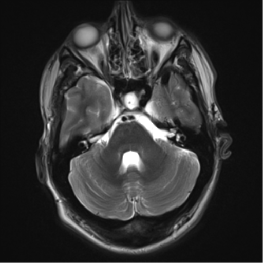 File:Cerebral arteriovenous malformation - huge (Radiopaedia 35734-37272 Axial T2 6).png