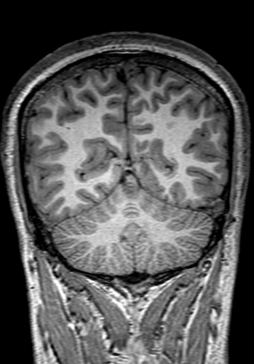 File:Cerebral arteriovenous malformation at posterior body of corpus callosum (Radiopaedia 74111-84925 Coronal T1 262).jpg