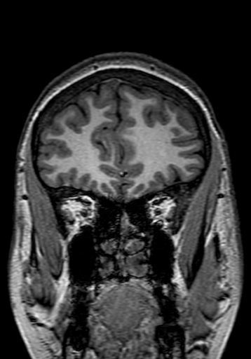 Cerebral arteriovenous malformation at posterior body of corpus callosum (Radiopaedia 74111-84925 Coronal T1 53).jpg