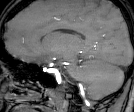 Cerebral arteriovenous malformation at posterior body of corpus callosum (Radiopaedia 74111-84925 J 233).jpg
