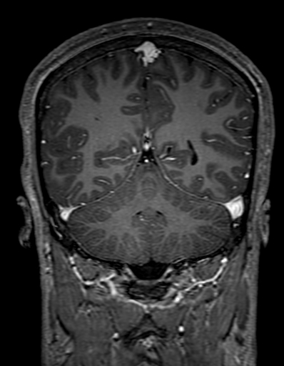 Cerebral arteriovenous malformation at posterior body of corpus callosum (Radiopaedia 74111-84925 K 267).jpg