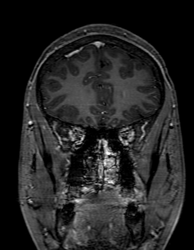 Cerebral arteriovenous malformation at posterior body of corpus callosum (Radiopaedia 74111-84925 K 83).jpg