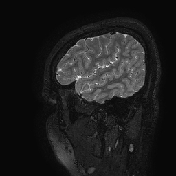 Cerebral arteriovenous malformation at posterior body of corpus callosum (Radiopaedia 74111-84925 Sagittal T2 120).jpg