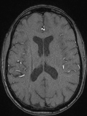 Cerebral arteriovenous malformation with hemorrhage (Radiopaedia 34422-35737 Axial MRA 49).png