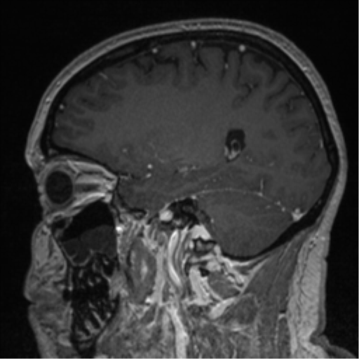 Cerebral cavernoma and development venous anomaly (Radiopaedia 37603-39482 Sagittal T1 C+ 63).png