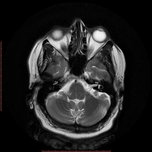 File:Cerebral cavernous malformation (Radiopaedia 26177-26306 Axial T2 6).jpg