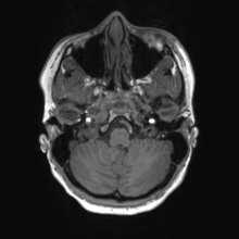 Cerebral cavernous venous malformation (Radiopaedia 70008-80021 Axial T1 11).jpg