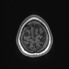 Cerebral cavernous venous malformation (Radiopaedia 70008-80021 Axial T1 88).jpg