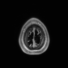 Cerebral cavernous venous malformation (Radiopaedia 70008-80021 Axial T1 C+ 96).jpg