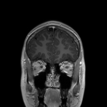 Cerebral cavernous venous malformation (Radiopaedia 70008-80021 Coronal T1 C+ 50).jpg