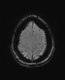 Cerebral cavernous venous malformation (Radiopaedia 70008-80021 I 66).jpg