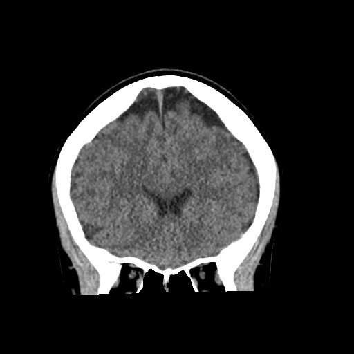 Cerebral cavernous venous malformation (Radiopaedia 70008-80022 non-contrast 23).jpg