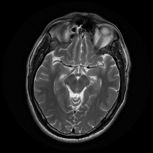 File:Cerebral cavernous venous malformation (Zabramski type II) (Radiopaedia 85511-101198 Axial T2 14).jpg