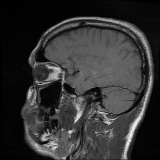 File:Cerebral cavernous venous malformation (Zabramski type II) (Radiopaedia 85511-101198 Sagittal T1 26).jpg