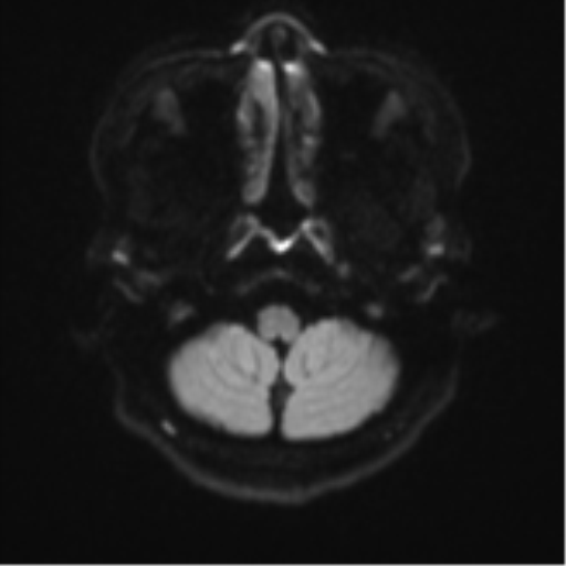 Cerebral cavernous venous malformations (Radiopaedia 48117-52946 Axial DWI 31).png