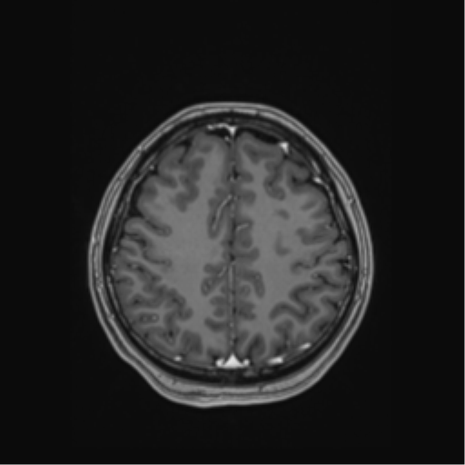 Cerebral cavernous venous malformations (Radiopaedia 48117-52946 Axial T1 C+ 47).png