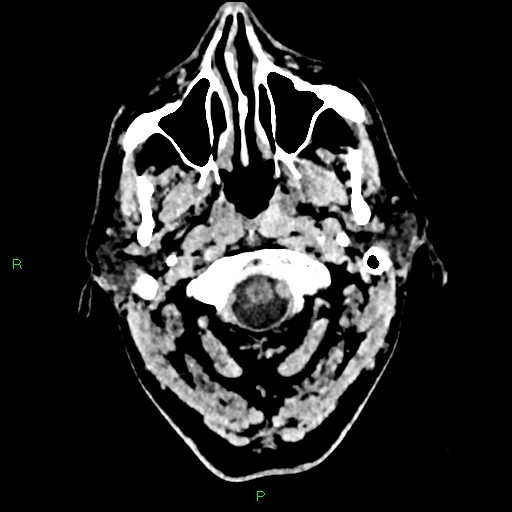 Cerebral contusions (Radiopaedia 33868-35039 Axial non-contrast 4).jpg